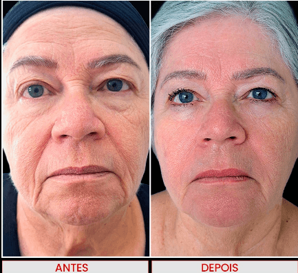 Microagulhamento com Skin Fill XSOME 2
